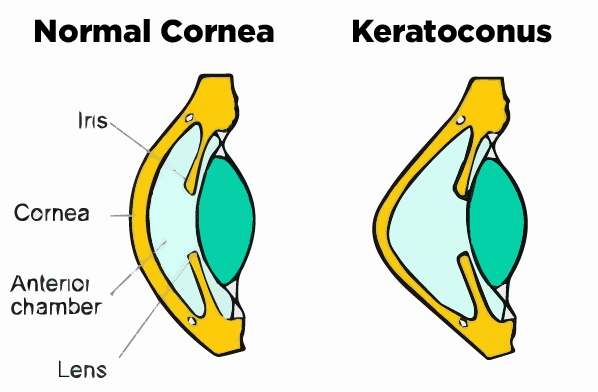 Keratoconus Diagram