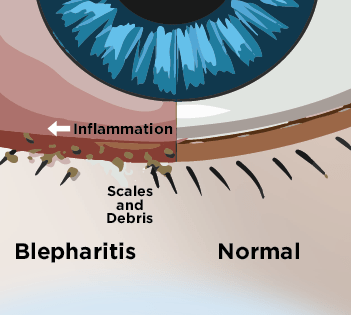 Eye Spa - Eye diagram for dry eye