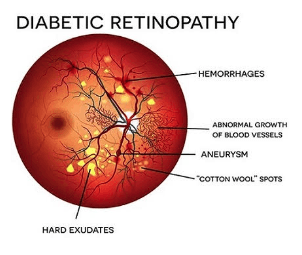 Diabetic retinopathy diagram