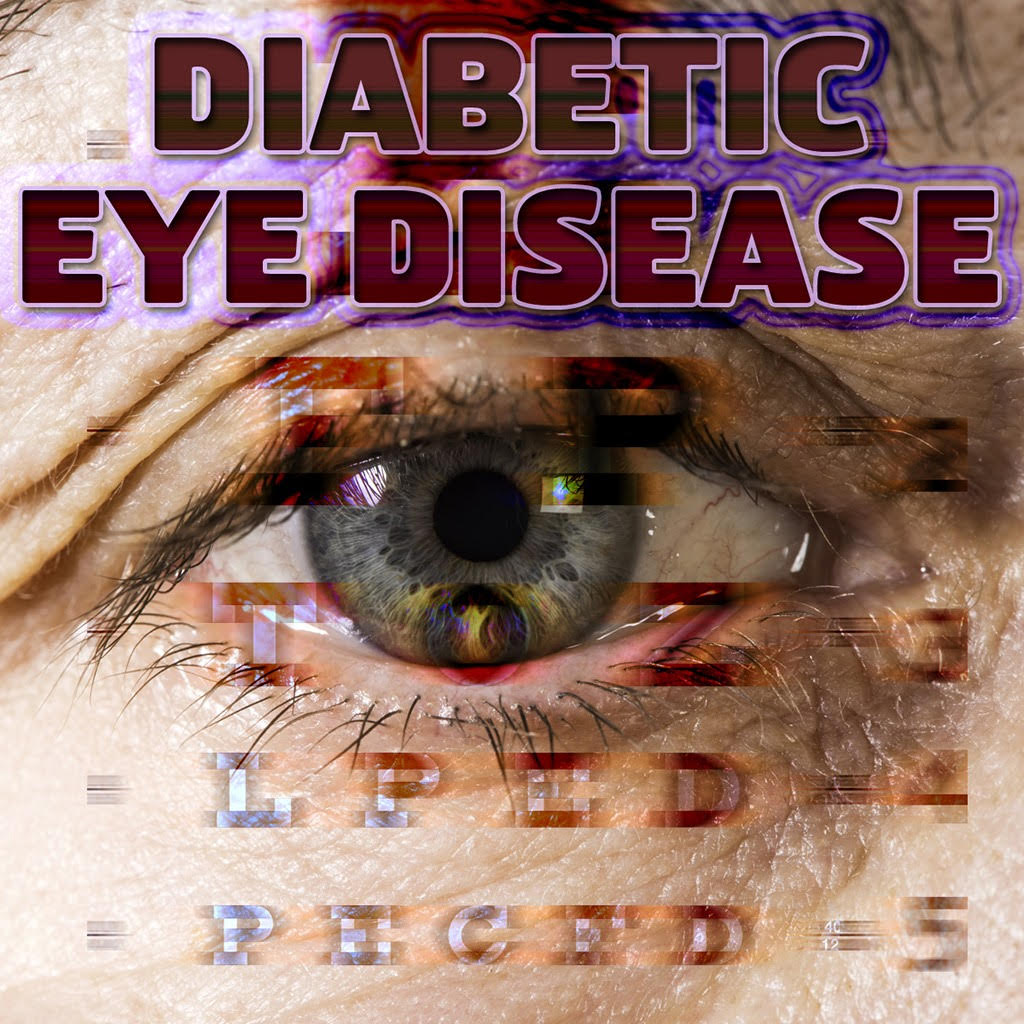 Diabetic Eye - Vision Express St Lucia - Diabetic Retinopathy