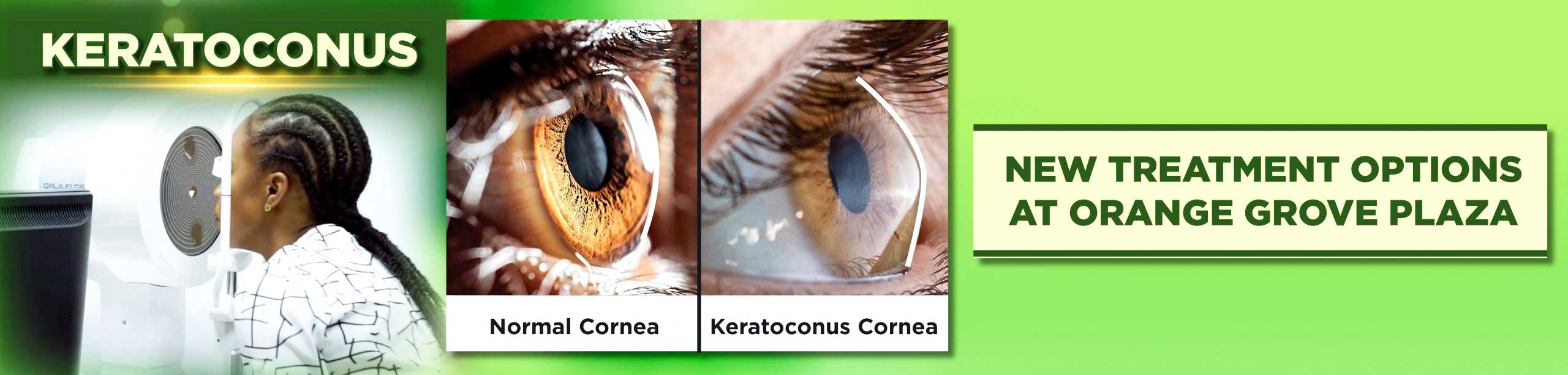 VIsion Express Saint Lucia Contact Lens for Keratoconus